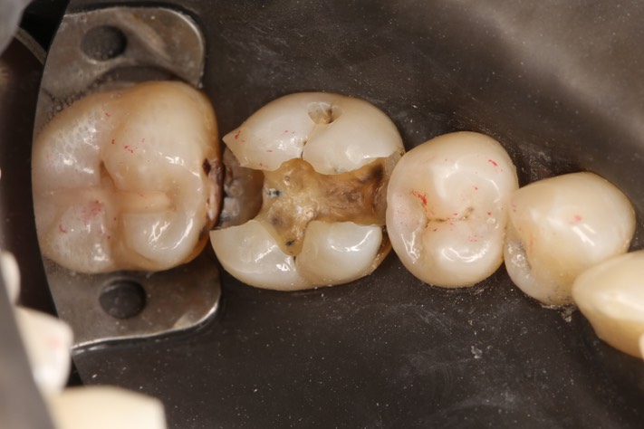 Scott Kanamori #30 caries removal