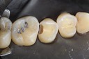 Ted Kanamori #13 caries removal