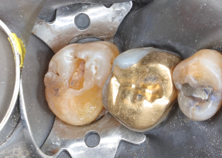 Ted Kanamori #15 amalgam removal