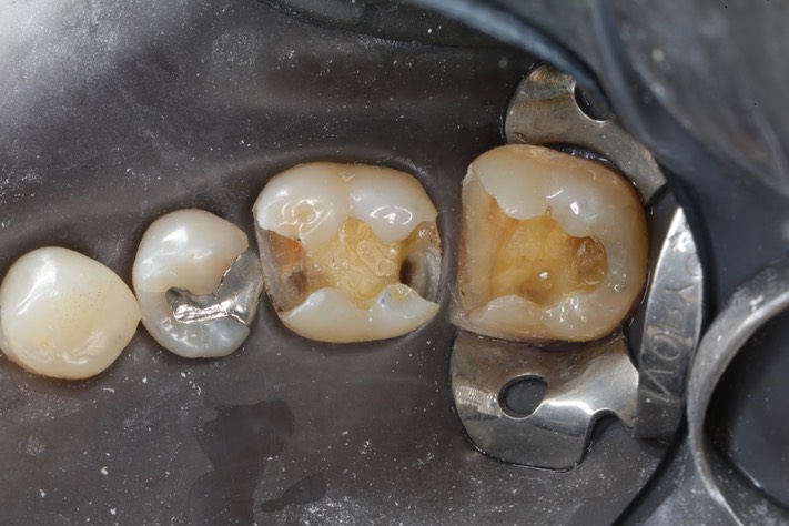 Ted Kanamori #18-19 amalgam removal