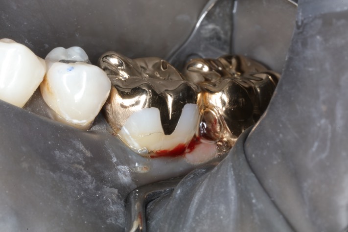 Ted Kanamori #18-19 finish buccal view