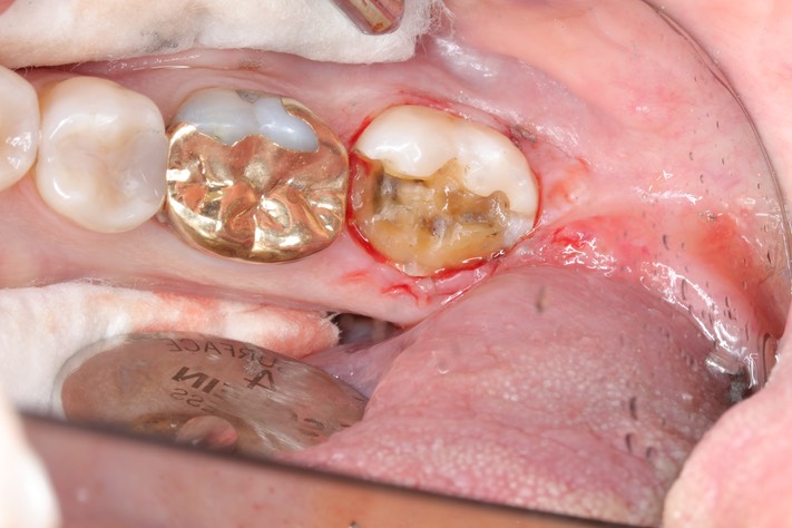 Ted Kanamori #18 amalgam removal