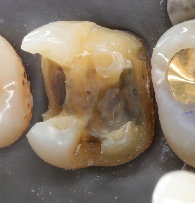 Ted Kanamori #3 crown removal – Version 2