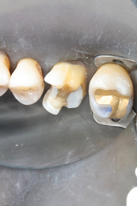 Ted Kanamori #3 prep - buccal