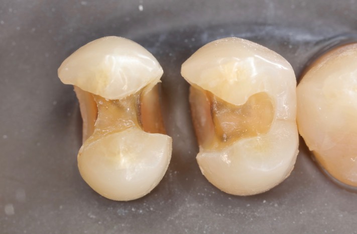 Ted Kanamori #4-5 caries removal 