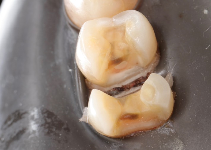 Ted Kanamori #4-5 prep 