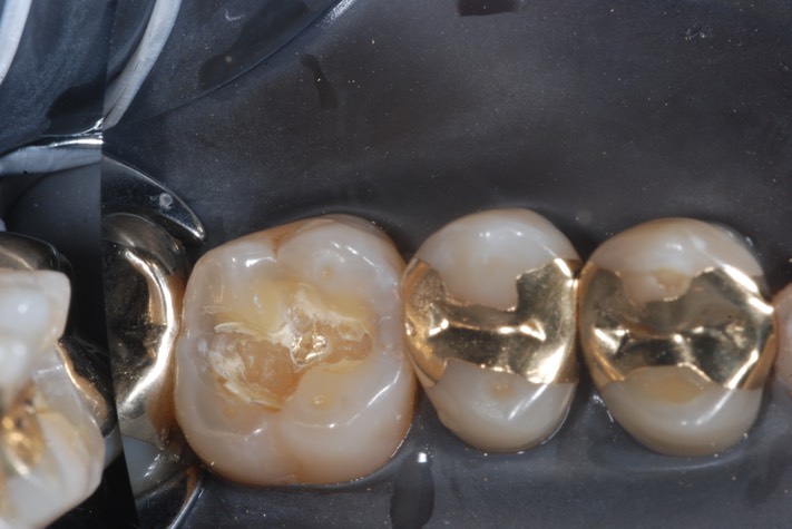 Terry Young #14 inlay removal