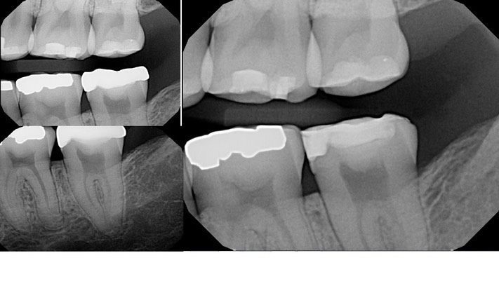 Kris NIp #18 bitewing radiograph