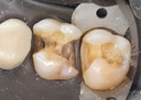 Wayne Chin #2-3 caries removal 