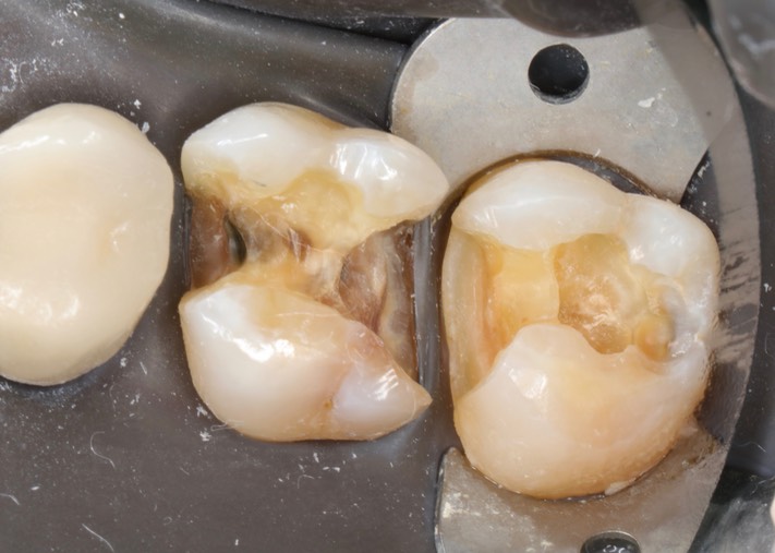 Wayne Chin #2-3 caries removal 