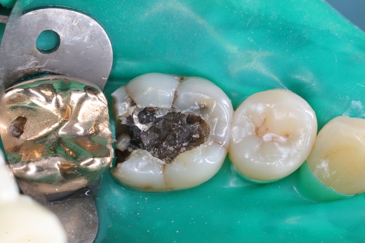 Wayne Chin #30 amalgam removal