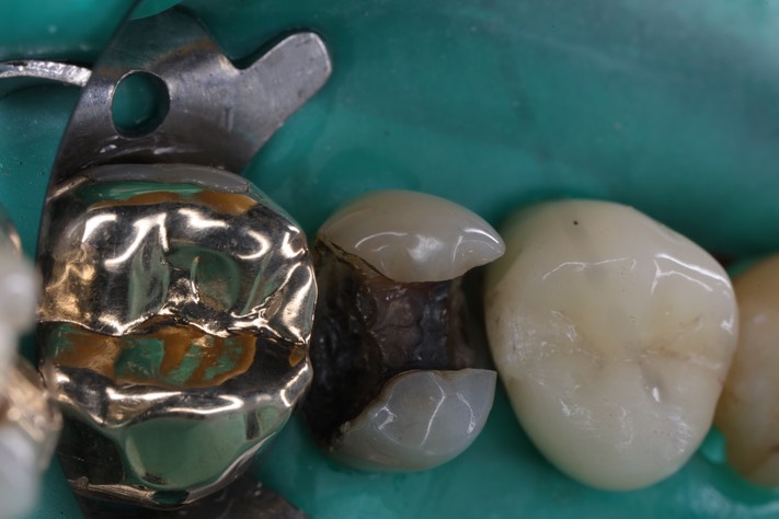 Wes Sato #13 amalgam removal