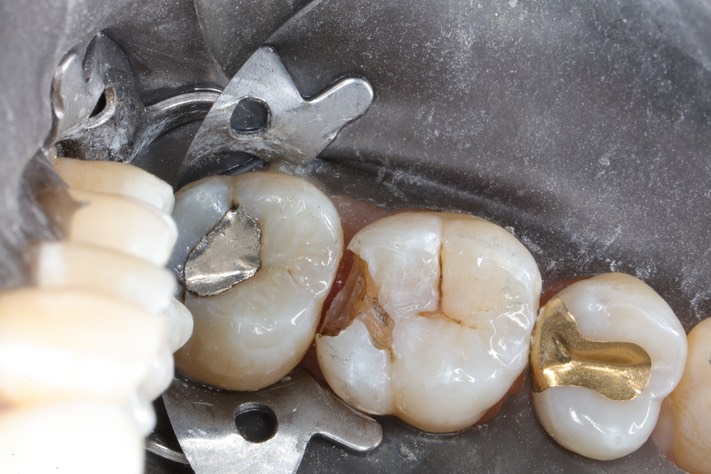 Wes Sato #14 amalgam removal