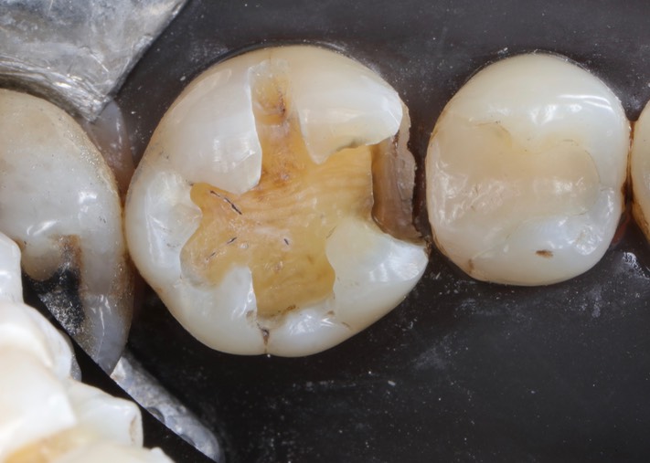 Wes Sato #30 caries removal