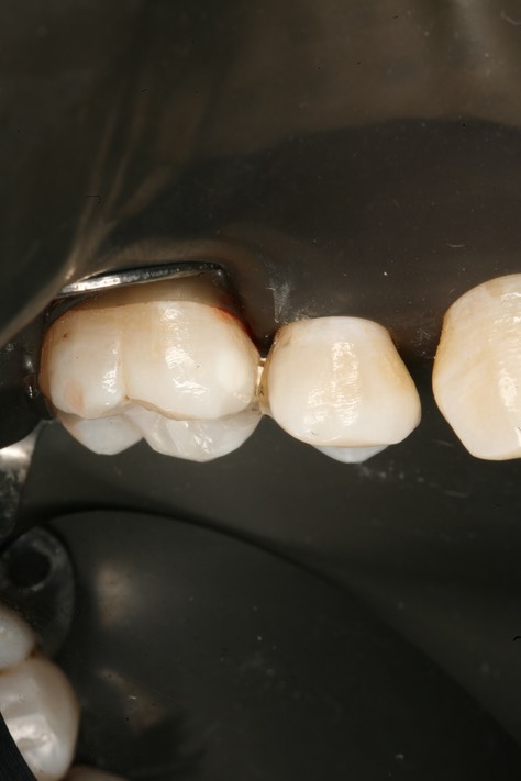 Wes Sato #4 finish - buccal  view